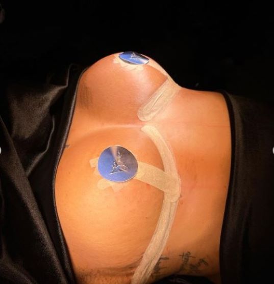 breast-reduction-surgery